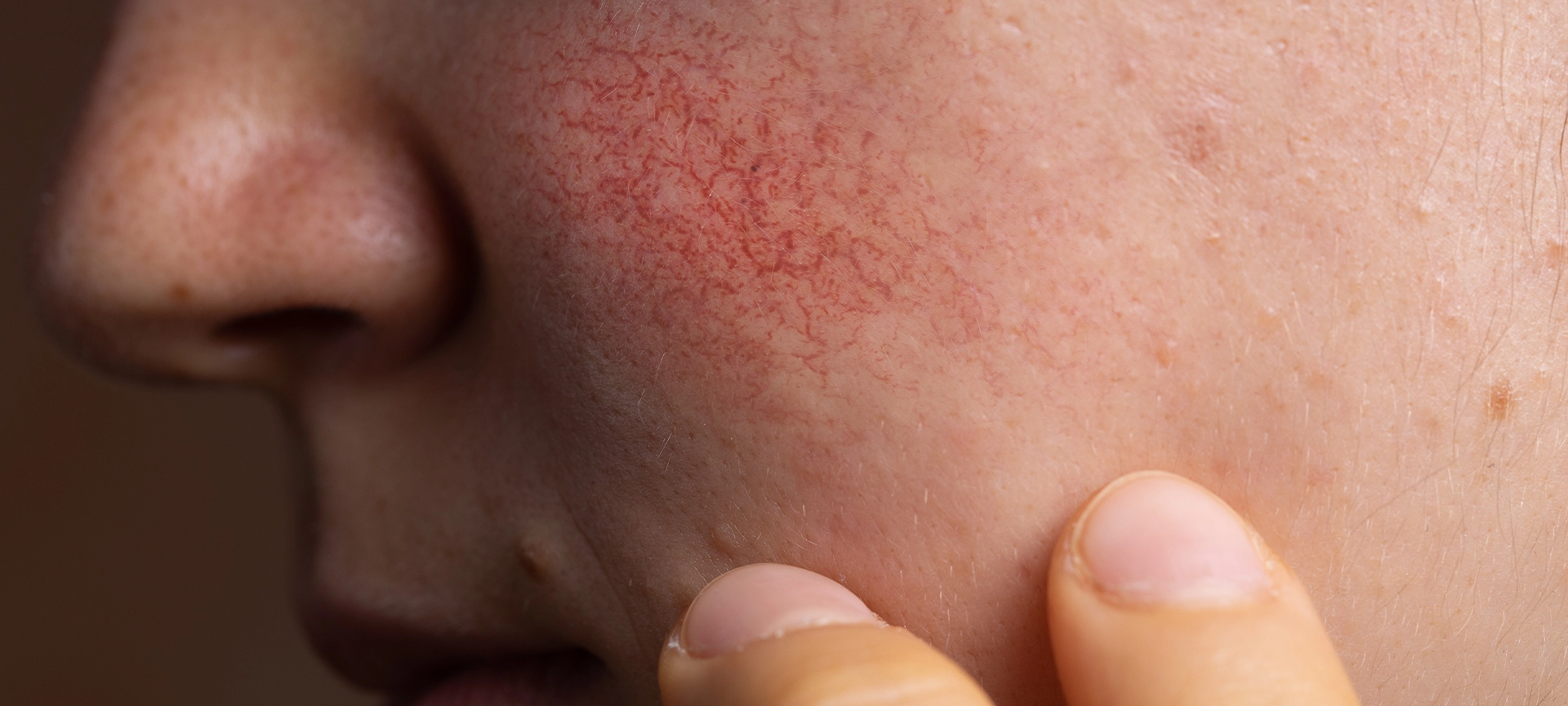 spider veins on face