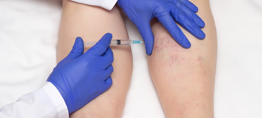 injections for spider veins