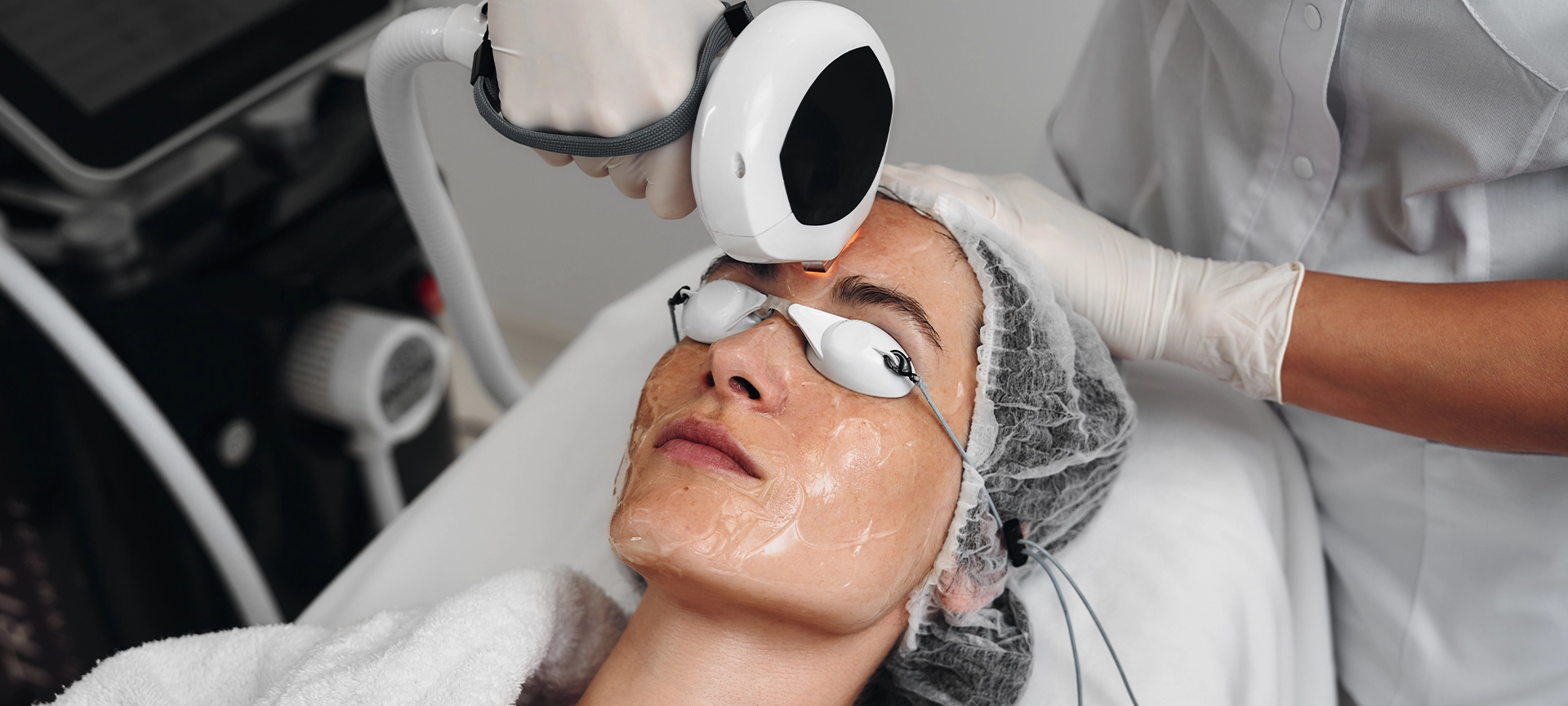 ipl treatment for acne scar